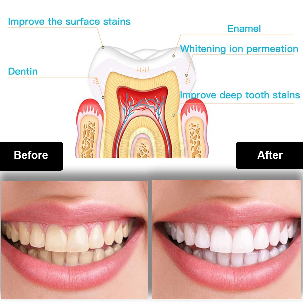 Kit de clareamento dental dos  - Teeth Whitening Laser avaliação e preço